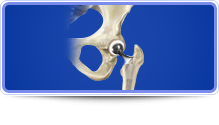 Hip Reconstruction - Carlos Gonzalez-Sandoval,M.D.