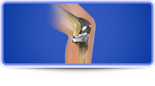 Knee Reconstruction - Carlos Gonzalez-Sandoval,M.D.
