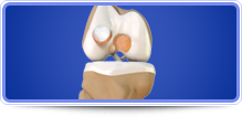 Cartilage Restoration - Carlos Gonzalez-Sandoval,M.D.